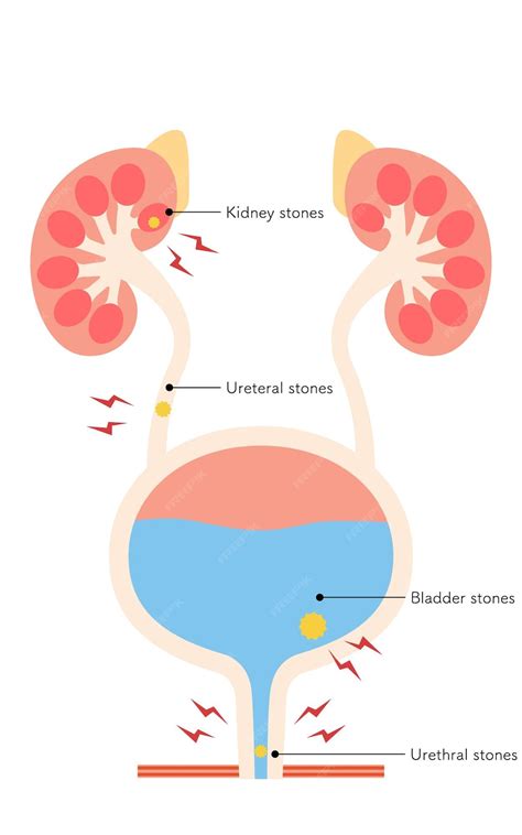Stones In Urine Bladder