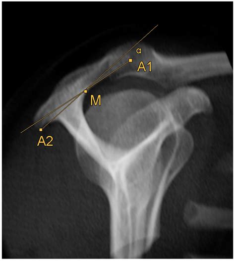 Acromion Types Mri Radiology