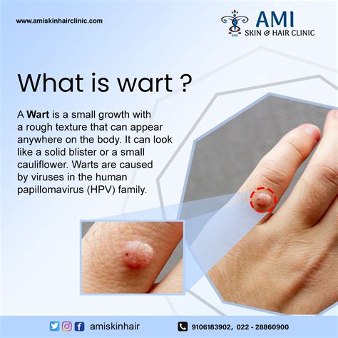 Warts can be unsightly & annoying. If you're bothered by warts, it may be comforting to know you ...