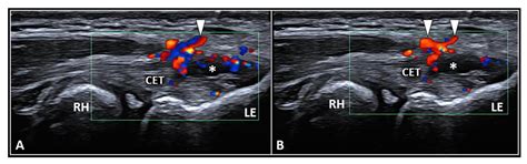 Ultrasonography for Injecting (Around) the Lateral Epicondyle ...