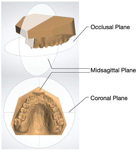 Dental Occlusion Characteristics for Treatment Decision-Making Regarding Surgery-First Approach ...