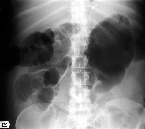 A woman with abdominal distension and pain | The BMJ