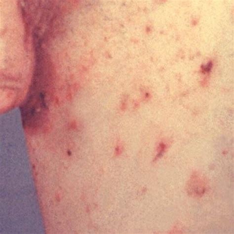 is scabies a parasite