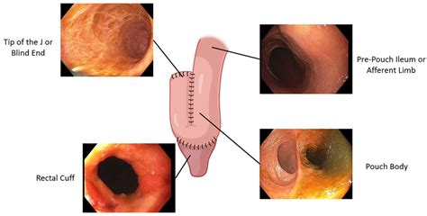 Image result for pouchoscopy