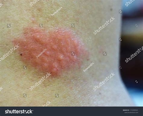 human bacterial skin rash