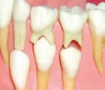 Image result for Deciduous Teeth