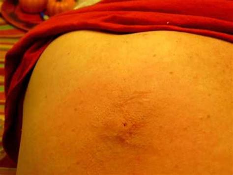 Image result for Extreme Zit Exploding