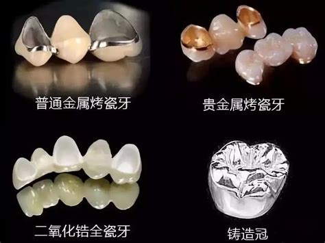 選擇最好的全瓷冠，妳值得擁有更美好的牙齒｜台中美齒專家-立頓牙醫診所