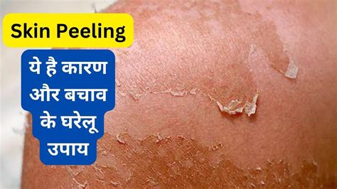 जानें क्या होती है Skin Peeling, गर्मियों में बचाव के ये है तरीके