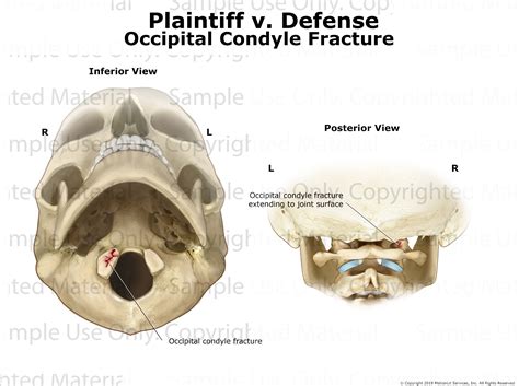 Occipital Condyle Fracture - MotionLit