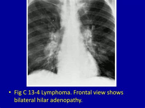 13 bilateral hilar enlargement | PPTX