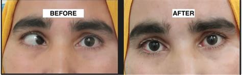 Best Doctor for Squint Surgery - Tewari Eye Centre