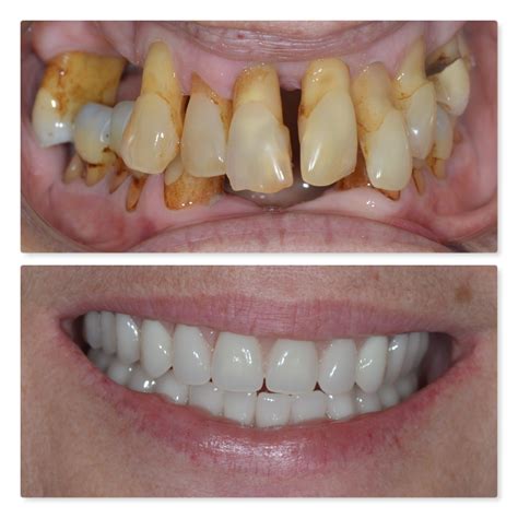 Dental Bone Loss Surgery at David Masterson blog