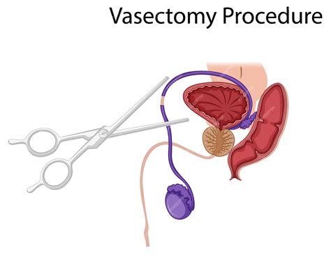 Premium Vector | Diagram showing Vasectomy Procedure