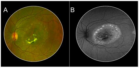 Retinal Imaging Findings in Inherited Retinal Diseases