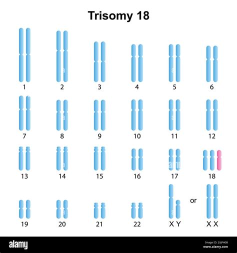 Trisomy 18 syndrome, illustration Stock Photo - Alamy