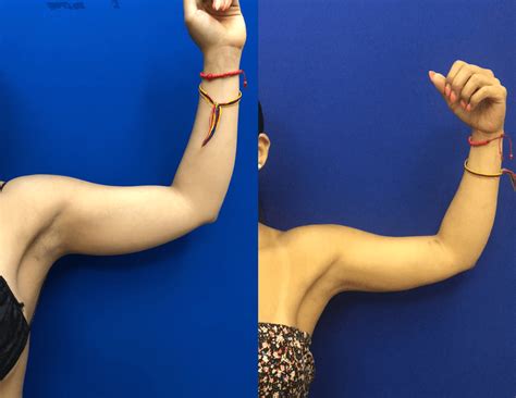 Arm Fat Removal