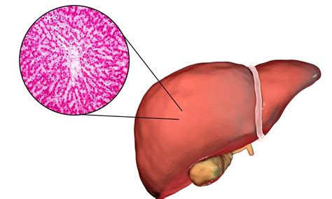 Non-invasive tests as effective as liver biopsy in predicting clinical ...