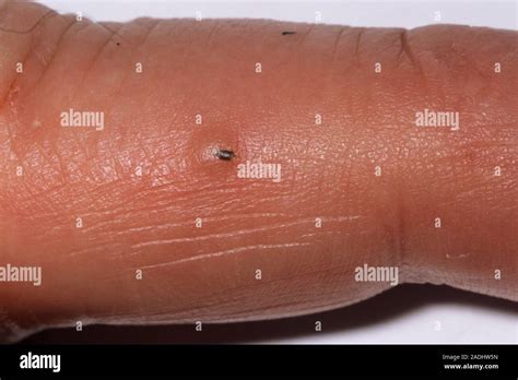 Image result for Splinter in Hand