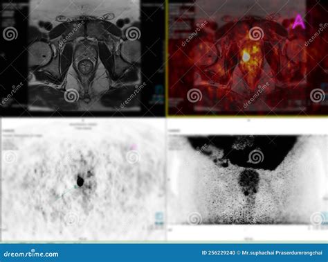 Positron Emission Tomography (PET) CT Scan of Whole Human Body Stock Photo - Image of human ...