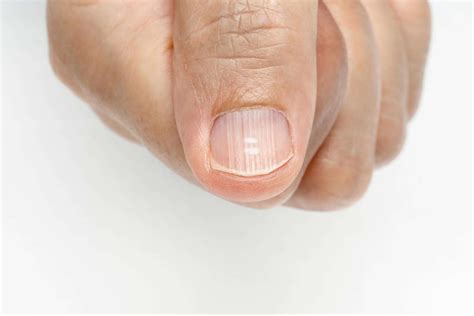 What Causes Ridges In Your Fingernails - MedicalRecords.com