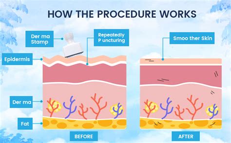 FI FIDROXIMPERIA Premium Derma Stamp 140 Titanium Adjustable ...