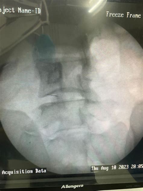 Image result for Nerve Root Block Lower Back