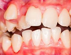 Image result for Malocclusion