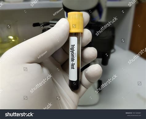 Blood Sample Triglyceride Test Medical Laboratory Stock Photo 1931300081 | Shutterstock