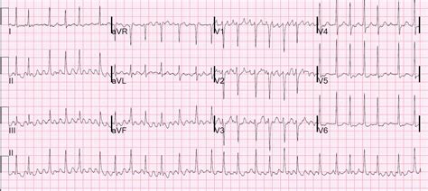 Image result for Atrial Flutter ECG Pattern