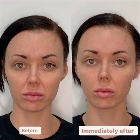 Image result for Cheek Threads