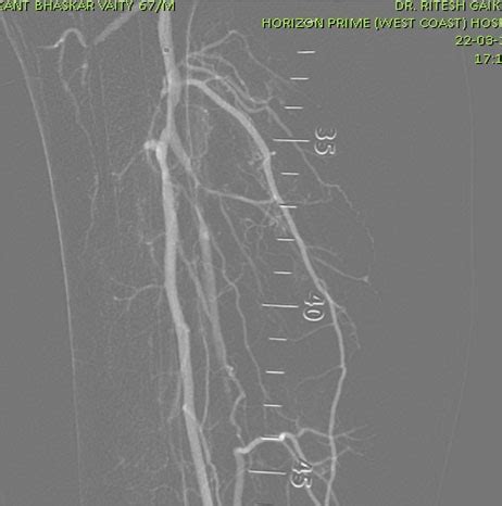 Below Knee and Thigh Artery Angioplasty (Balloon Dilation)
