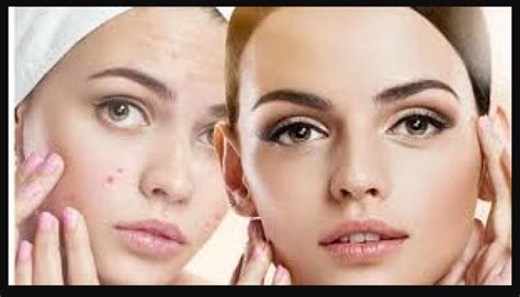 Home Remedies For Pimples: चेहरे पर निकल आए हैं पिंपल्स? घबराएं नहीं ...