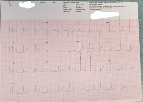 Ectopic Atrial Rhythm