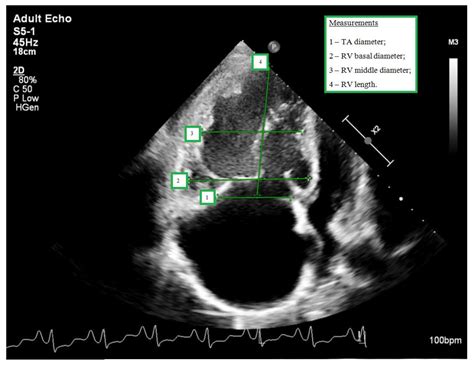 Different Causes of Functional Tricuspid Valve Regurgitation Are Linked to Differences in ...