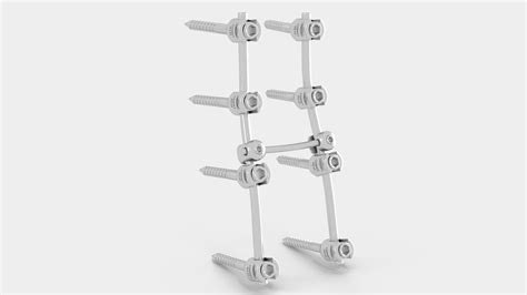 Lumbar Cervical Spine Fixation System 3D | 3D Molier International