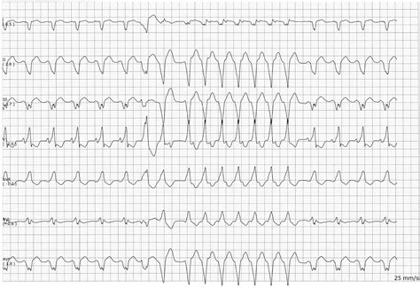 Sinus Rhythm with a Wide QRS Complex with a Run of Ventricular Tachyardia