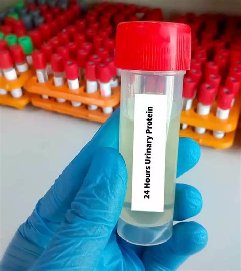 Causes & Signs Of Hand, Foot, And Mouth Disease In Pregnancy