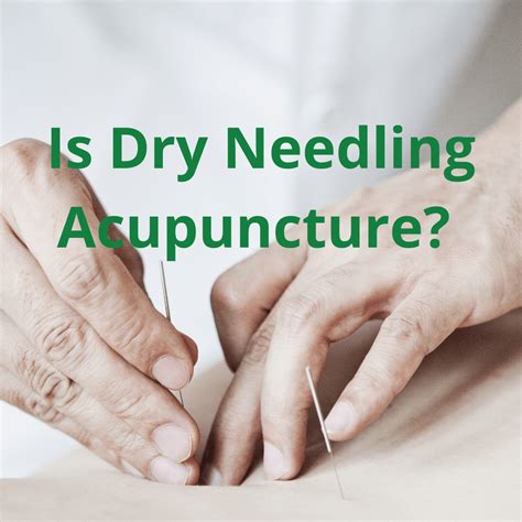 Dry Needling Vs Acupuncture: What’S The Difference? – KOQIB