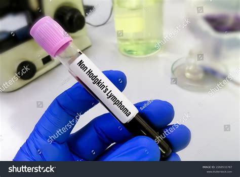 971 Tests Lymphoma Images, Stock Photos & Vectors | Shutterstock