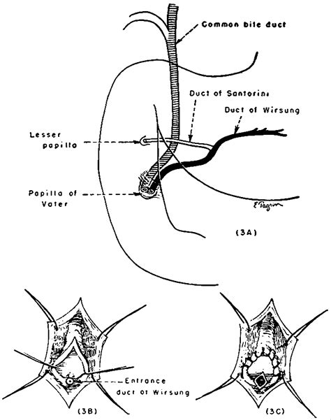 Treatment of Recurrent Pancreatitis by Transduodenal Sphincterotomy and ...