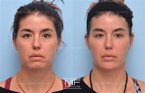 Drooping Brow Before and After Pictures Case 1166 | San Francisco, CA | Mabrie Facial Institute