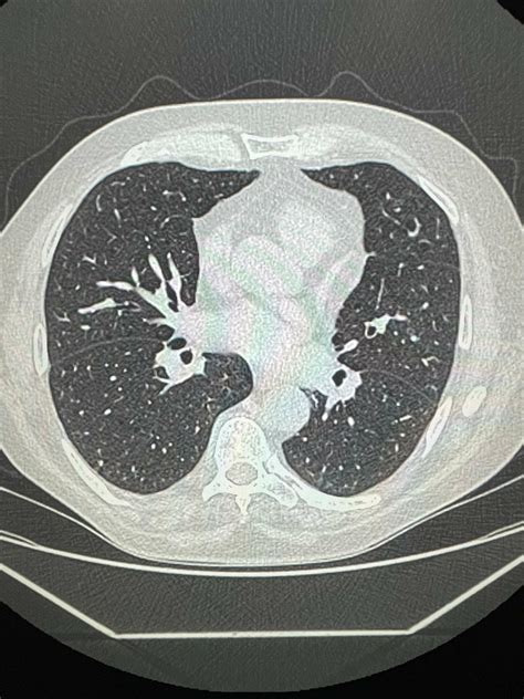 Image result for Poumon Normal Scanner