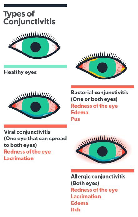 આંખ આવવી ( કન્જકટીવાઇટીસ ) CONJUCTIVITIS