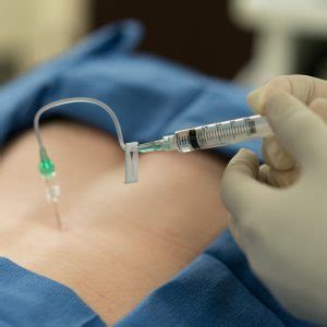 Image result for Selective Nerve Root Block Contrast Spread Pattern