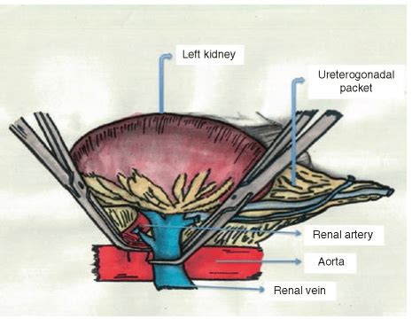 Image result for Open Nephrectomy Procedure