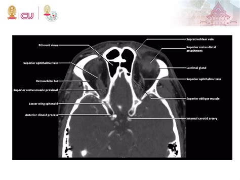 Anatomy of Orbit and Lacrimal system | PDF