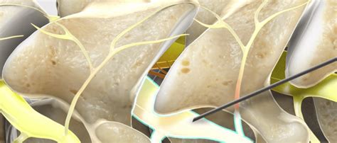 Image result for Selective Nerve Root Block vs Transforaminal