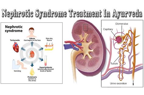 Nephrotic syndrome: Ayurveda treatment