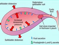 Image result for cholecyst